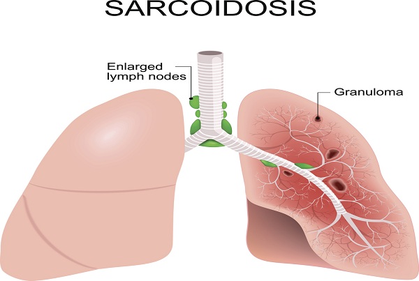 Sarcoidosis