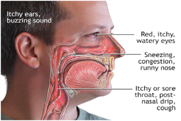 Nasobronchial Allergy