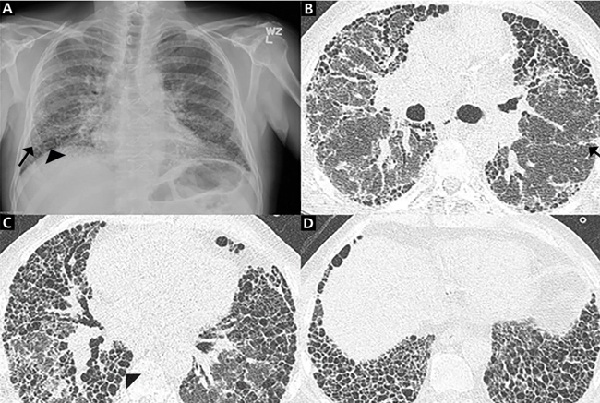 Lung Fibrosis