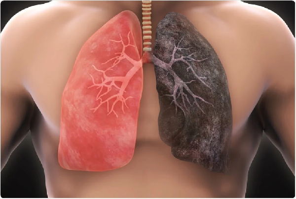 Lung Cancer