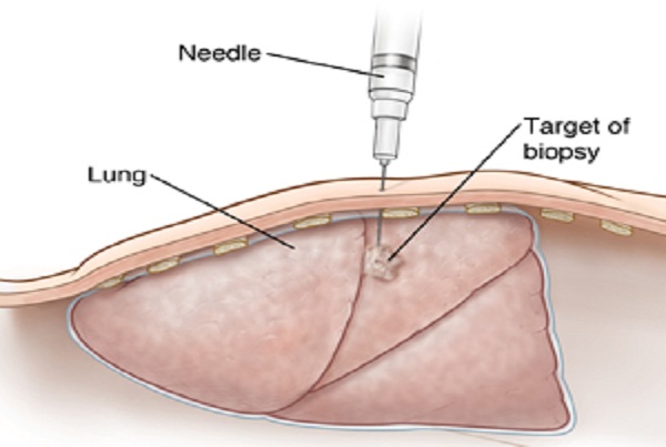 Lung Biopsy