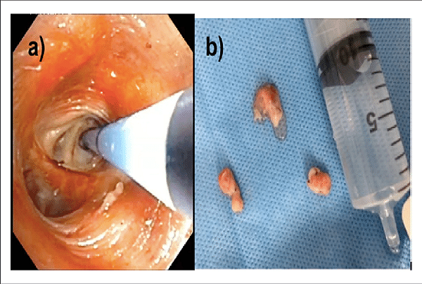 Lung Cryobiopsy