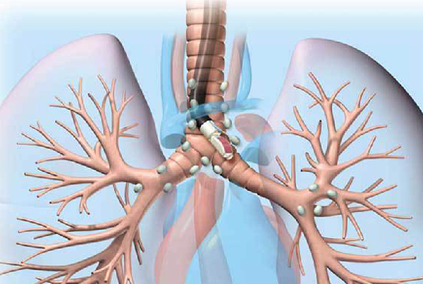 Diagnostic EBUS