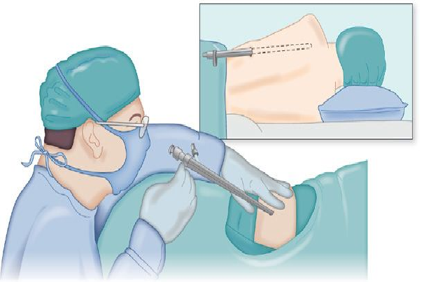 Diagnostic Thoracoscopy