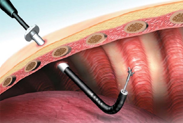 Pleural Biopsy