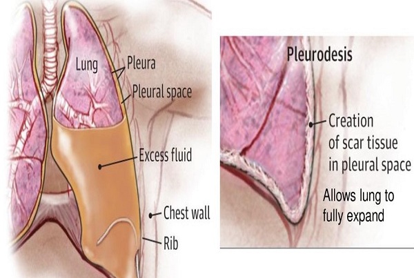 Pleurodesis