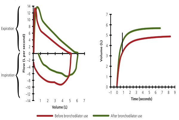 Pulmonary Function Test with Bronchodilator Reversibility