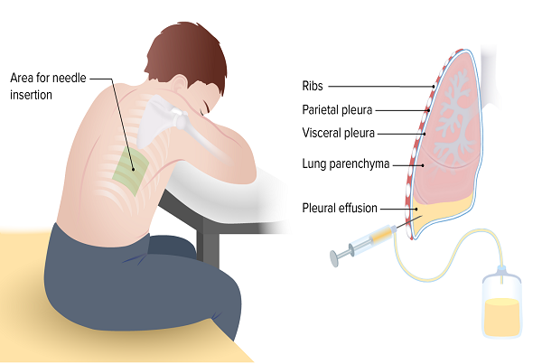 Pleural Tapping