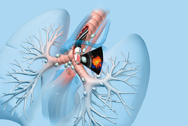 Endobronchial Ultrasound